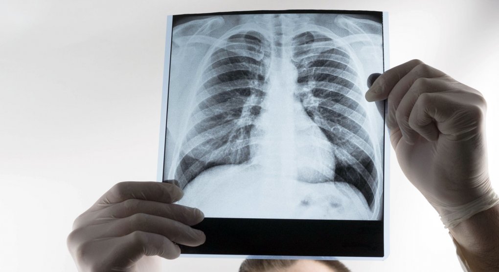 Včasné vyšetření plic může zachránit život. Proč ho polovina Čechů odmítá?