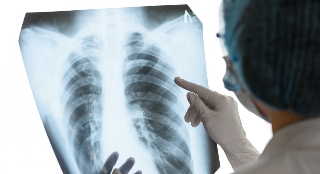 V Česku roste počet případů tuberkulózy. Jsme připraveni, ubezpečuje lékař